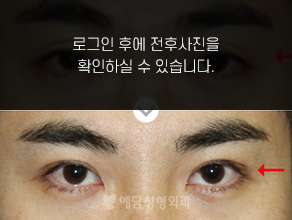 매몰법 쌍꺼풀수술
