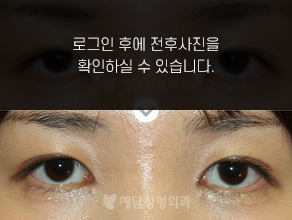 앞트임