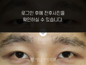 절개법 쌍꺼풀수술