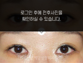 앞트임