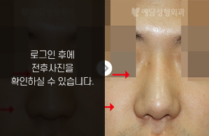 낮은코성형