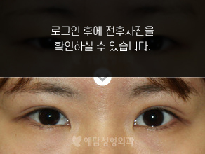 매몰법 쌍꺼풀수술
