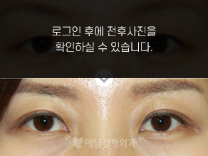 매몰법 쌍꺼풀수술
