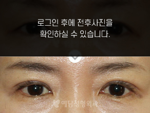 매몰법 쌍꺼풀수술