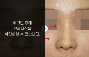 낮은코성형