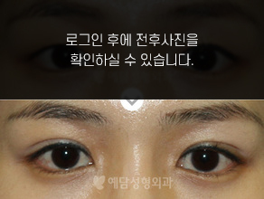 매몰법 쌍꺼풀수술