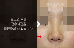 낮은코성형