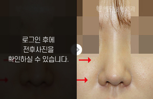 코재수술(코 끝 찝힘)