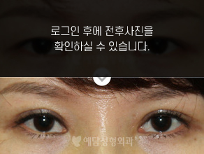 절개법 쌍꺼풀수술