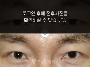 절개법 쌍꺼풀수술
