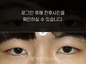 앞트임