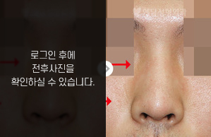 낮은코성형