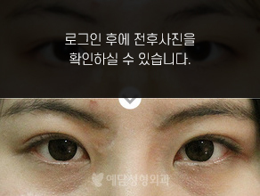 매몰법 쌍꺼풀수술