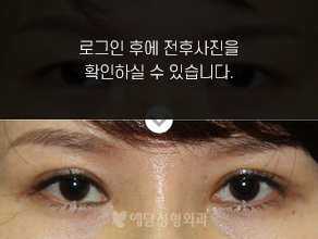 눈재수술