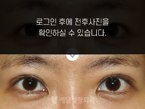눈재수술