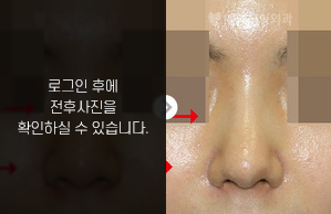 낮은코성형