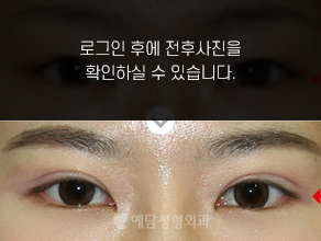 매몰법 쌍꺼풀수술
