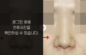 복코성형