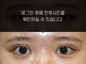 절개법 쌍꺼풀수술