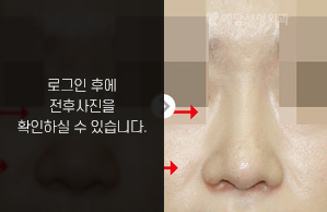 낮은코성형