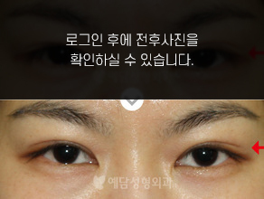 매몰법 쌍꺼풀수술