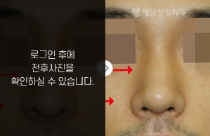매부리코성형
