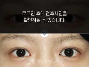 매몰법 쌍꺼풀수술