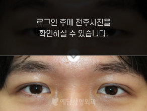 절개법 쌍꺼풀수술