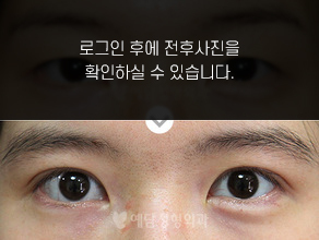 부분절개 쌍꺼풀수술