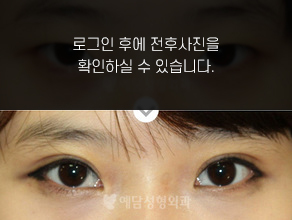 절개법 쌍꺼풀수술
