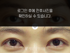 눈재수술