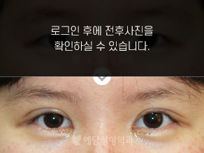 절개법 쌍꺼풀수술+앞트임