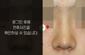 낮은코성형
