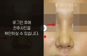 낮은코성형