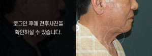 기억 목주름성형
