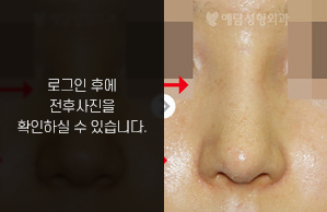 매부리코성형