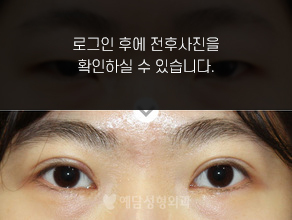절개법 쌍꺼풀수술+앞트임