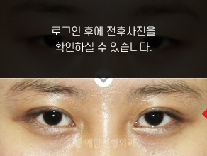 매몰법 쌍꺼풀수술