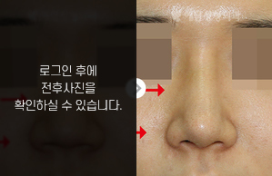 매부리코성형