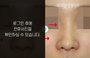 낮은코성형