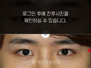 매몰법