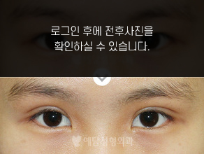 부분절개법 쌍꺼풀수술