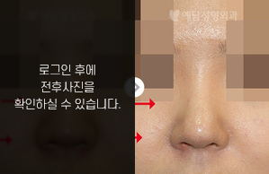 짧은코성형