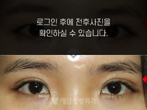 매몰법 쌍꺼풀수술