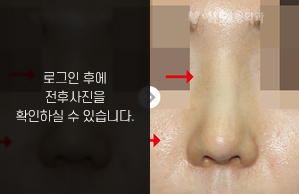 코재수술