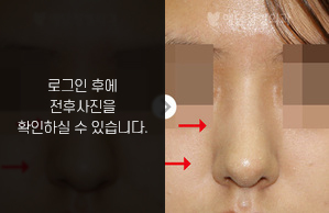 휜코성형