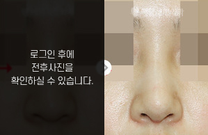 휜코성형