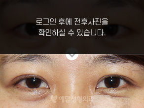 절개법 쌍꺼풀수술