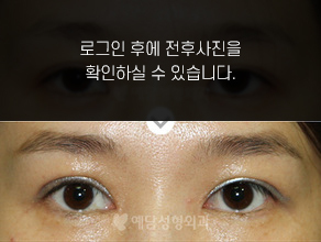 눈재수술