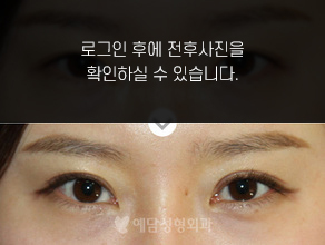 절개법 쌍꺼풀수술